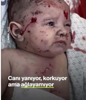 <p>Saldırılarından etkilenen birkaç aylık bir bebeğin tüm vücudunun yara bere içinde olduğu görüldü. Saldırıdan kurtulan Gazzeli minik bebek yaşadığı şokun ve acıların etkisiyle ağlayamadı.</p>