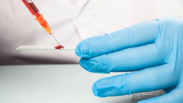 <p>Genç bireylerdeki felç vakalarının, arterlerde yağ birikiminden ziyade pıhtı oluşumu ile ilgili olduğu düşünülüyor.</p>
<p> </p>