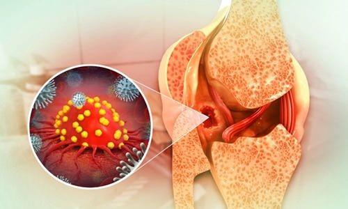 <p><strong>Prostatın kötü huylu tümörü:</strong></p>
<p>3295 Kişi</p>
<p> </p>
<p><strong>Böbreğin kötü huylu tümörü:</strong></p>
<p>935 Kişi</p>
<p> </p>
<p><strong>Mesanenin kötü huylu tümörü:</strong></p>
<p>2439 Kişi</p>