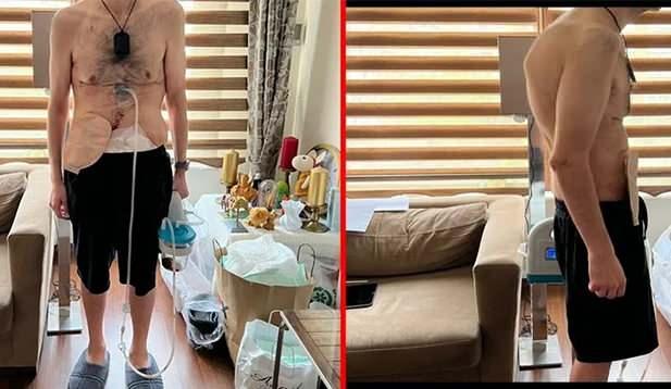<p>İlker Ergün (37), bağırsak tıkanıklığı nedeniyle 2 yıl önce İstanbul Gaziosmanpaşa’da bulunan özel bir hastaneye gitti. Ergün’ünün iddiasına göre, kendisine uygulanan yanlış tedavi nedeniyle hem midesinden oldu hem de kalın bağırsağının bir metresini kaybetti. Son iki yılda 14 kez ameliyat olan Ergün’ün sağlık durumu günbegün kötüye gidiyor. 100 kilodan 52 kiloya düşen Ergün, sağlığına kavuşmak istiyor.</p>

<p> </p>
