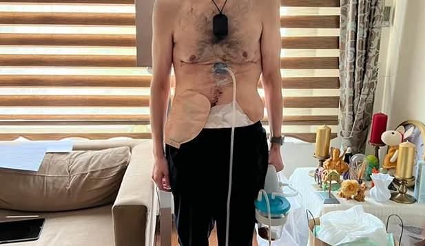 <p>Çok uzun süredir tedavi gördüğünü ve hâlâ iyileşemediğini belirten Ergün, <strong>"2 yılda 14 ameliyata girdim. Enfeksiyon da kaptım. Hastane, hem benden hem SGK'dan para tahsis etmiş. Ayrıca SGK sisteminde hâlâ midem var görünüyor, çünkü rapor sahte."</strong> İfadelerini kullandı.</p>

