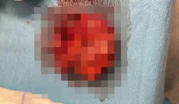 <p>Verdikleri hiçbir evrak doğru olmadığını iddia eden Ergün, <strong>"Savcılığa da şikâyette bulunduk ama hâlâ ifadeleri alınmadı. Şu anda Adli Tıp'tan rapor bekliyoruz. Hastane özür bile dilemedi. Şu anda öyle bir durum var ki; Sahte rapor verildiği için SGK sisteminde mide ve bağırsağım var gözüküyor. Hiçbir devlet hastanesi hasta olarak beni kabul etmiyor, tedavi olamıyorum. Elimde midemin ve bağırsağımın olmadığına dair raporu uzattığımda 'Bu sistemde yok, işlem yapamayız' diyorlar. Bu yüzden de özel hastanelerde hizmet almak durumunda kalıyorum. Bu süreçte şu ana kadar resmi faturalı 30 milyona yakın harcama yapmak durumunda kaldım."</strong> dedi.</p>