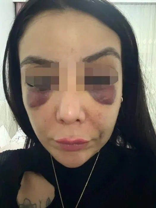 <p>Bu esnada arkasından gelen F.H., tuvaletin kapısını kapatıp, genç kadına yumrukla saldırmaya başladı. Yüzüne çok sayıda darbe alan A.T.S., baygınlık geçirdi. Bunun üzerine F.H., genç kadını dövmeyi bırakıp, tuvaletten çıkıp gitti.</p>