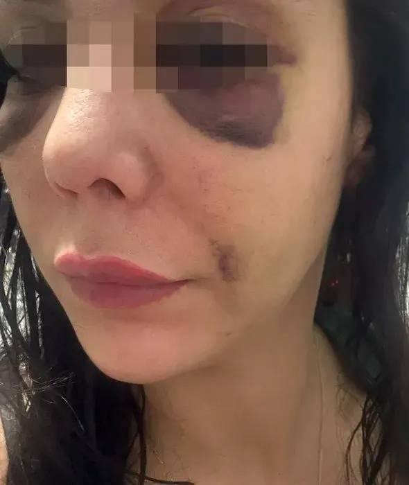 <p>Feci olay anına ilişkin detaylar ortaya çıkarken, genç kadının yüzünün tanınmaz hale geldiği öğrenildi. </p>