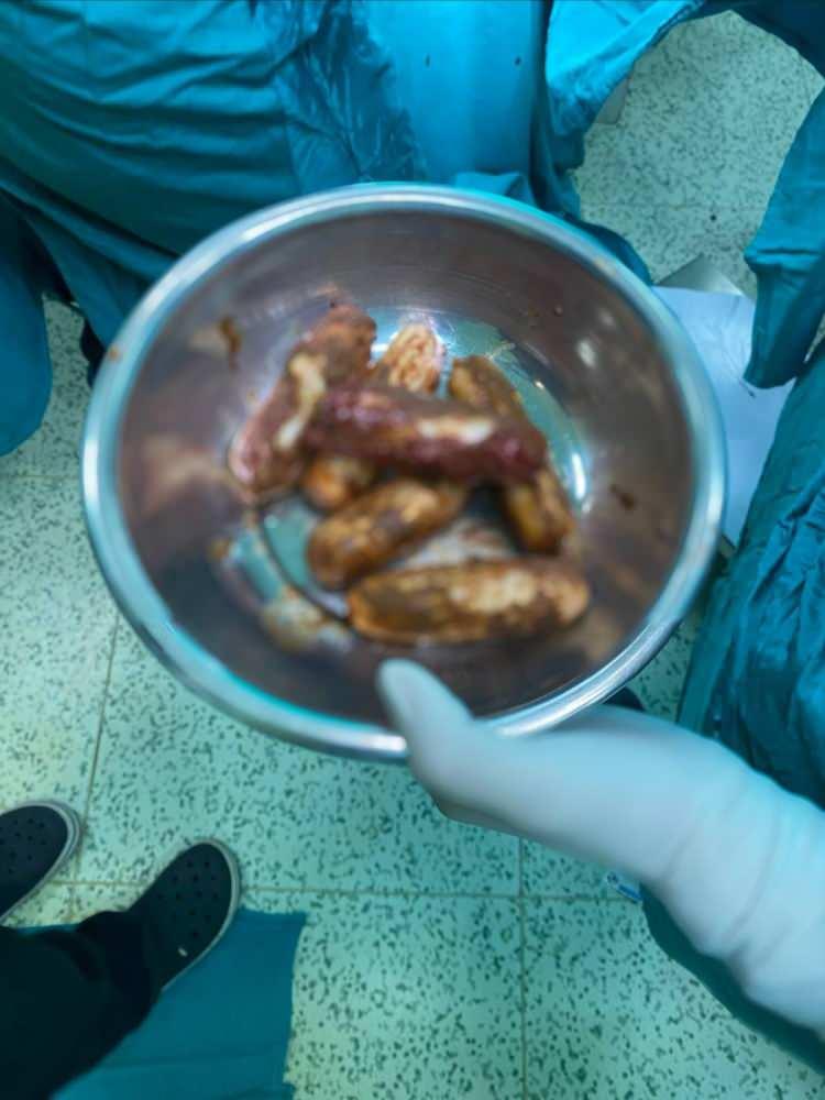 <p>Şüphelinin hayati tehlike oluşturabilecek şekilde sakladığı paketler, cerrahi müdahaleyle çıkarıldı. İncelemede paketlerin içinde toplam 350 gram metamfetamin olduğu tespit edildi.</p>
<p> </p>