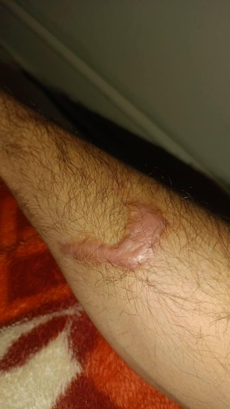<p>Ağabeyine yardım etmek isteyen H.Ü. ise eriyen kıyafetleri çıkarmaya çalışırken vücudunda yanıklar oluştu.</p>