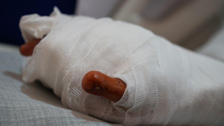 <p>Ameliyat sonrası Kırpaç, yeni başparmağına kavuştu. Parmağını hareket ettirmeye başlayan genç hasta, günlük yaşamına daha rahat devam edebileceği için mutlu olduğunu belirtti.</p>
