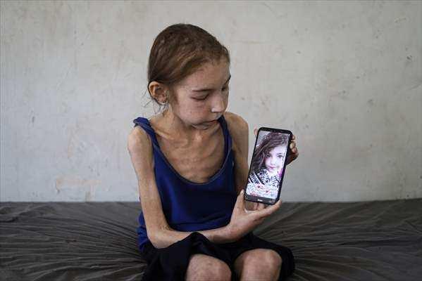 <p>Rahaf'ın hastalığının yeni ortaya çıkmadığını ancak eskiden iyi beslendiği için anlaşılmadığını kaydeden Ağa, <strong>"Bu hastalık ablukayla birlikte net bir şekilde ortaya çıktı. Bu kız çocuğu bu şekilde devam eder ve kilo kaybı yaşarsa bağışıklık sistemi zayıflar ve akut enfeksiyonlar gelişebilir ve bu da ölüme kadar gidebilir."</strong> dedi.</p>
<p> </p>