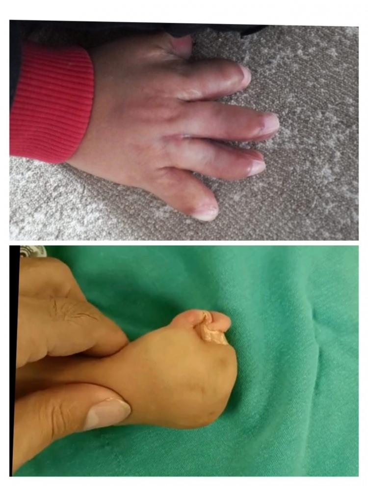 <p>2'si kız 3 çocuğa sahip 45 yaşındaki Nuriye-Adem Şahin çiftinin doğuştan Apert sendromu olan oğulları 4 yaşındaki Umut Aras Şahin'in ellerindeki parmakları birleşik biçimde doğdu. </p>