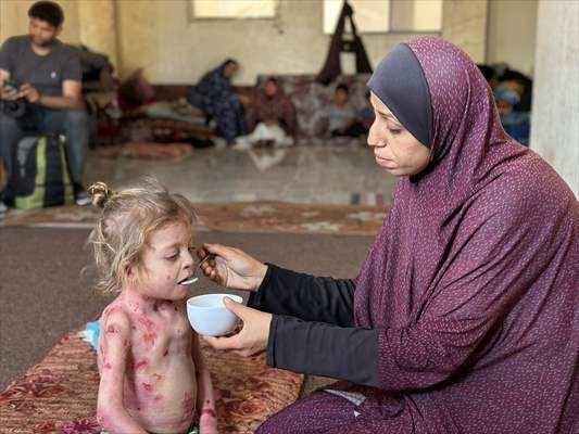 <p>Gazze'nin kuzeyindeki Şucaiyye Mahallesinden Cela Mahallesine göç eden Haccac ailesinin 8 ferdinden biri olan küçük Nur, nadir görülen ve tedavisi olmayan Epidermolizis Bülloza (kelebek hastalığı) adlı bir cilt hastalığıyla mücadele ediyor. </p>