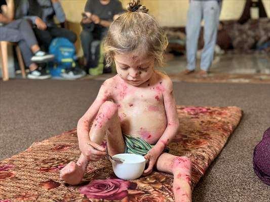 <p>Gazze'ye gıda ve ilaç girişi olmadığı için ise durumu her geçen gün daha da kötüye gidiyor.</p>