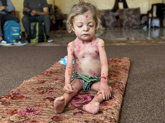 <p>Kızı Nur'un çok zor bir hastalığı olduğunu söyleyen anne Vela, yeterli ilaç ve yiyecek bulunmadığı için Nur'un 8 kiloya düştüğünü belirtti.</p>
<p> </p>