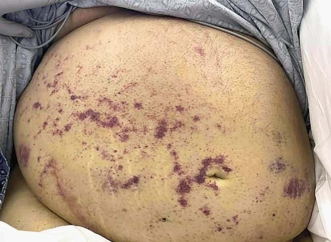 <p><span style="color:#000000">Antibiyotik ve antiviral tedavilere rağmen bir türlü iyileşmeyen hastanın karın bölgesinde morarma ve döküntüler de başlamıştı.</span></p>