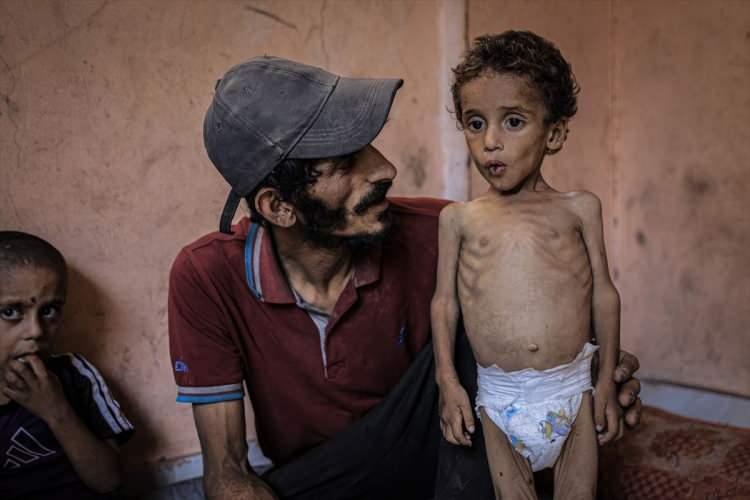 <p>BİR BEBEK DAHA CAN VERMEK ÜZERE </p>
<p>İsrail'in yönelik saldırıları ve abluka nedeniyle gıda krizinin yaşandığı Gazze'de 2 yaşındaki çocuk Yezen Ebu Ful'un, yetersiz beslenme nedeniyle durumu giderek kötüleşiyor.</p>