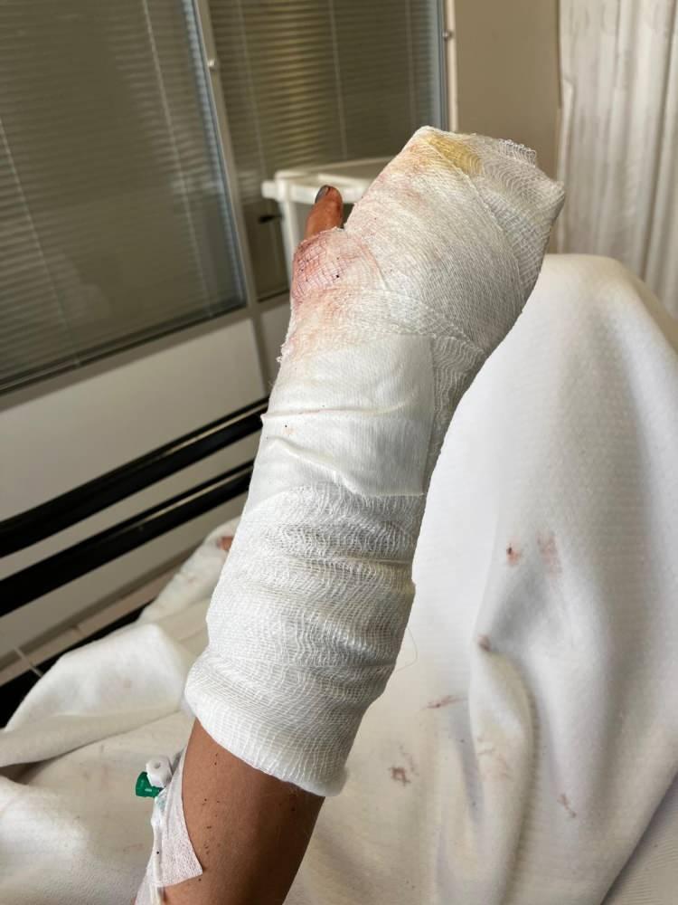 <p>Saldırı sırasında elleriyle başını korumaya çalışan Iryna'nın sol elinde çok sayıda kırık oluştu. Kafatasında beyin kanaması riski taşıyan yaralanmalar nedeniyle Antalya Eğitim ve Araştırma Hastanesi'ne kaldırılan Iryna Melnychuk D., 16 gün boyunca hastanede tedavi gördü.</p>
