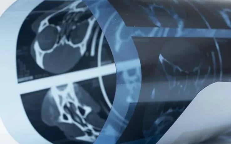 <p>Genel Cerrahi Uzmanı Op. Dr. İsmet Çelik ve Gastroenteroloji Uzmanı Doç. Dr. Aydın Aktaş'ın liderliğindeki ekip tarafından gerçekleştirilen operasyon, yaklaşık iki saat sürdü. Zorlu ameliyatta, dev kistlerden ikisi tamamen çıkarılırken, üçüncü kistin içi boşaltılarak kontrol altına alındı. Bu başarılı müdahale, hastanın hayati tehlikesini ortadan kaldırdı ve durumunun stabilleşmesini sağladı.</p>