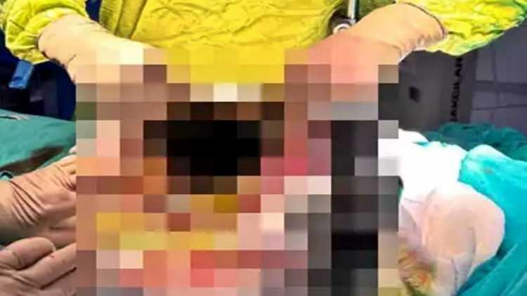 <p>Hastanın yandaş hastalıkları olmasına rağmen, multidisipliner bir yaklaşımla yapılan konsey değerlendirmesi sonucunda ameliyat kararı alındığı belirtildi. </p>