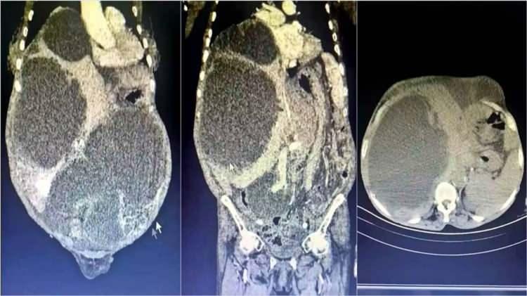 <p>Bu paraziter hastalığa, genellikle sokak hayvanları veya veteriner kontrolünden geçmemiş evcil hayvanların dışkısıyla doğrudan temas ya da dışkı bulaşmış toprak, su ve yiyecekler aracılığıyla insan vücuduna giren parazitlerin neden olduğu açıklandı. Kistin zamanla karaciğer, akciğer ve diğer organlara yerleşerek ciddi sağlık sorunlarına yol açabileceği konusunda uyarılarda bulunuldu.</p>
