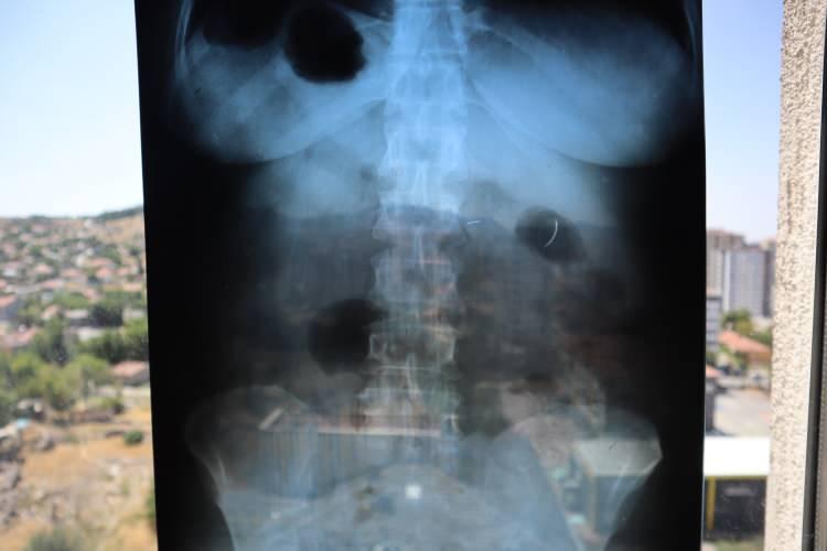 <p>Kendisini özel hastanede ameliyat eden Genel Cerrahi Doktoru İ.D.’ye dava açan Tanyıldız, ağrılarının nedeninin karnında unutulan ameliyat iğnesi olduğunu öğrendi. 19 yıl sonra mahkemesi de sonuçlanan Tanyıldız, bir miktar tazminat almaya hak kazandı.</p>
