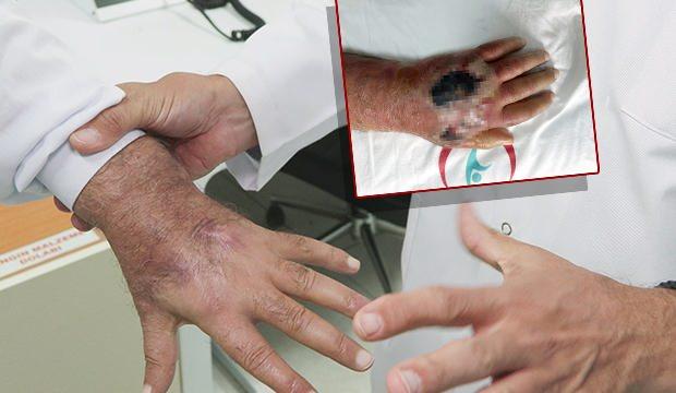 <p>Üsküdar'da esnaflık yapan 60 yaşındaki adam, dükkanına giren hırsızlar nedeniyle adeta dehşeti yaşadı. Hırsızların ısırması sonucunda neredeyse kolunı kaybetme noktasına giren adam, literatüre girmeye hazırlanıyor. </p>