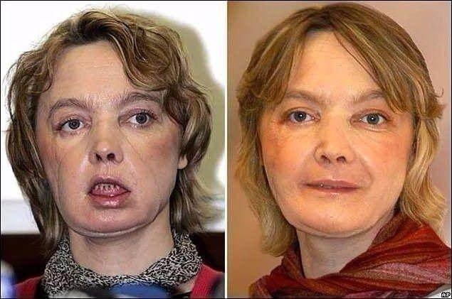 <p>Dünyanın ilk kısmi yüz nakli gerçekleştirilen insanı Isabelle Dinoire (2005)</p>