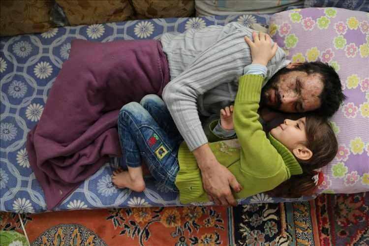 <p>"Gözyaşı'nın Babası İçin Çağrısı Karşılık Buldu" başlıklı fotoğrafta, Suriye'nin İdlib kentinde rejime ait savaş uçaklarından atılan varil bombası nedeniyle iki bacağını, sağ el parmaklarını, gözlerini ve işitme yetisini kaybeden 27 yaşındaki Mamun Halid Nasır'a yardım eli uzatılmasının ardından, 5 yaşındaki kızı Gözyaşı'nın mutluluğu objektife yansıyor. (2017)</p>
