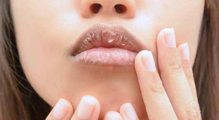 <p><span style="color:#000000"><strong>Hava koşulları ve susuzluğun önem arz ettiği bu etki, birkaç hafta içinde iyileşme göstermediği takdirde bir uzmana görünmenizde fayda var.</strong></span></p>