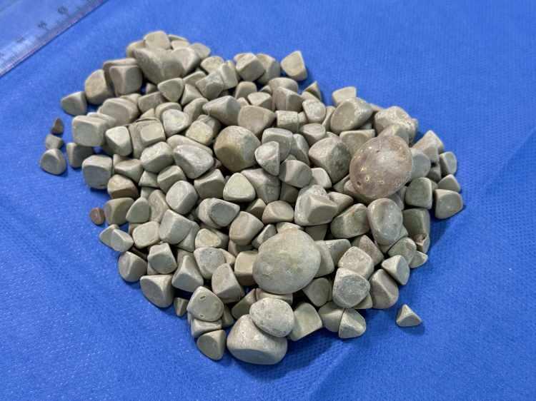 <p><strong>Hastalık sürecini anlatan Öztürk, <span style="color:#800080"><em>"80-100 tane falandır diyorduk, 287 tane deyince gerçekten çok şaşırdık. Oturunca bile çok ağrıyordu. Şu an kendimi çok iyi hissediyorum"</em></span> dedi.</strong></p>
