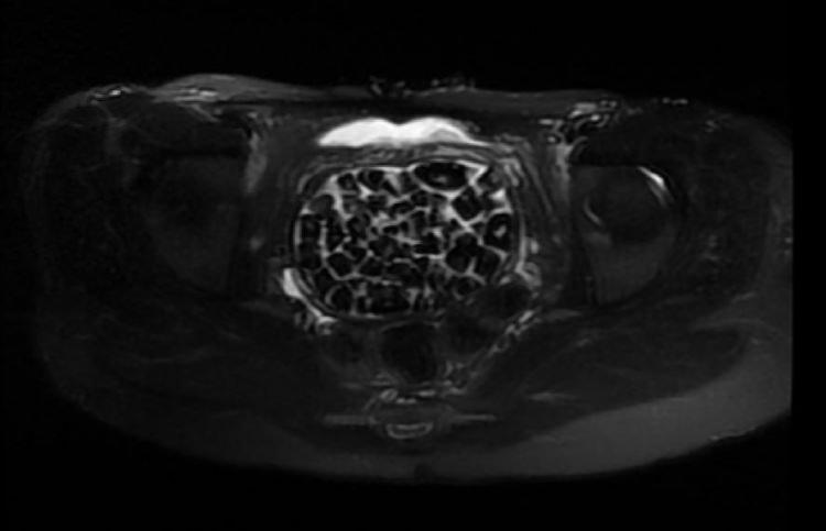 <p><strong>"LİTERATÜRDE ÇOK NADİR GÖRÜLEN BİR OLAY"</strong></p>

<p><strong>Taşlar hem sağlık ekibini hem hasta ve ailesini şok ederken uzmanlar, <span style="color:#800080"><em>"Mesaneden vajene geçtiğimiz esnada tüm vajenin taşlarla dolu olduğunu gördük. Biz de o kadar taş beklemiyorduk, çok şaşırdık, en büyüğü 2,5 santim boyutlarında olan irili ufaklı 287 taş. Literatürde çok nadir görülen bir olay"</em></span> açıklamasını yaptı.</strong></p>
