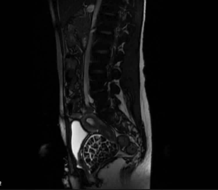 <p><strong>LİTERATÜRDE İKİNCİ VAKA</strong></p>

<p> </p>

<p><strong>Hastasının durumuna yönelik konuşan Üroloji Uzmanı Doç. Dr. Erkan Erkan, "Hastamız 50 binde bir görülen bir anomaliden dolayı art arda ameliyatlar geçirdiğini öğrendik. Mesanesinin olması gereken yerin hemen arka kısmında taşlarla dolu bir kese olduğunu gördük. O kadar taş beklemiyorduk, çok şaşırdık. Literatürde sanırım yayınlanmış 2'nci vaka olacak" dedi.</strong></p>
