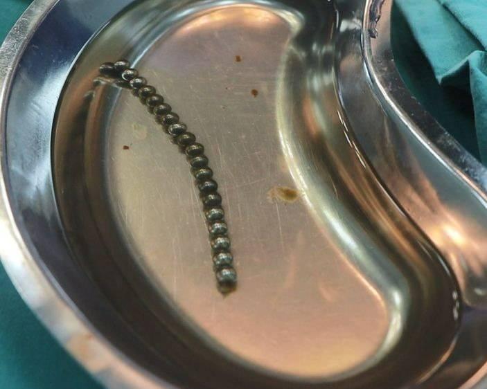 <p>Fırat Üniversitesi Çocuk Gastroenteroloji Hepatoloji ve Beslenme Bilim Dalı Başkanı Prof. Dr. Yaşar Doğan, çocuk hastanın yemek borusuna yapışmış 19 mıknatısı endoskopik yöntemle çıkardı.</p>
