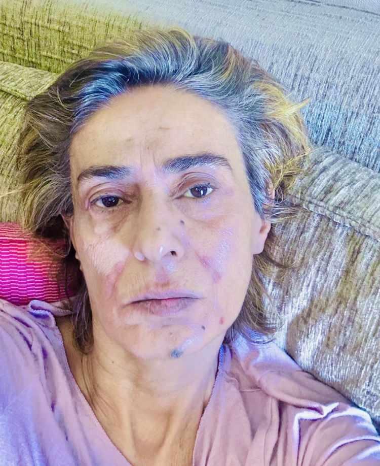 <p>İğne fobisi olduğunu söyleyen ünlü sanatçıya, kremlerle müdahale edildi.</p>
