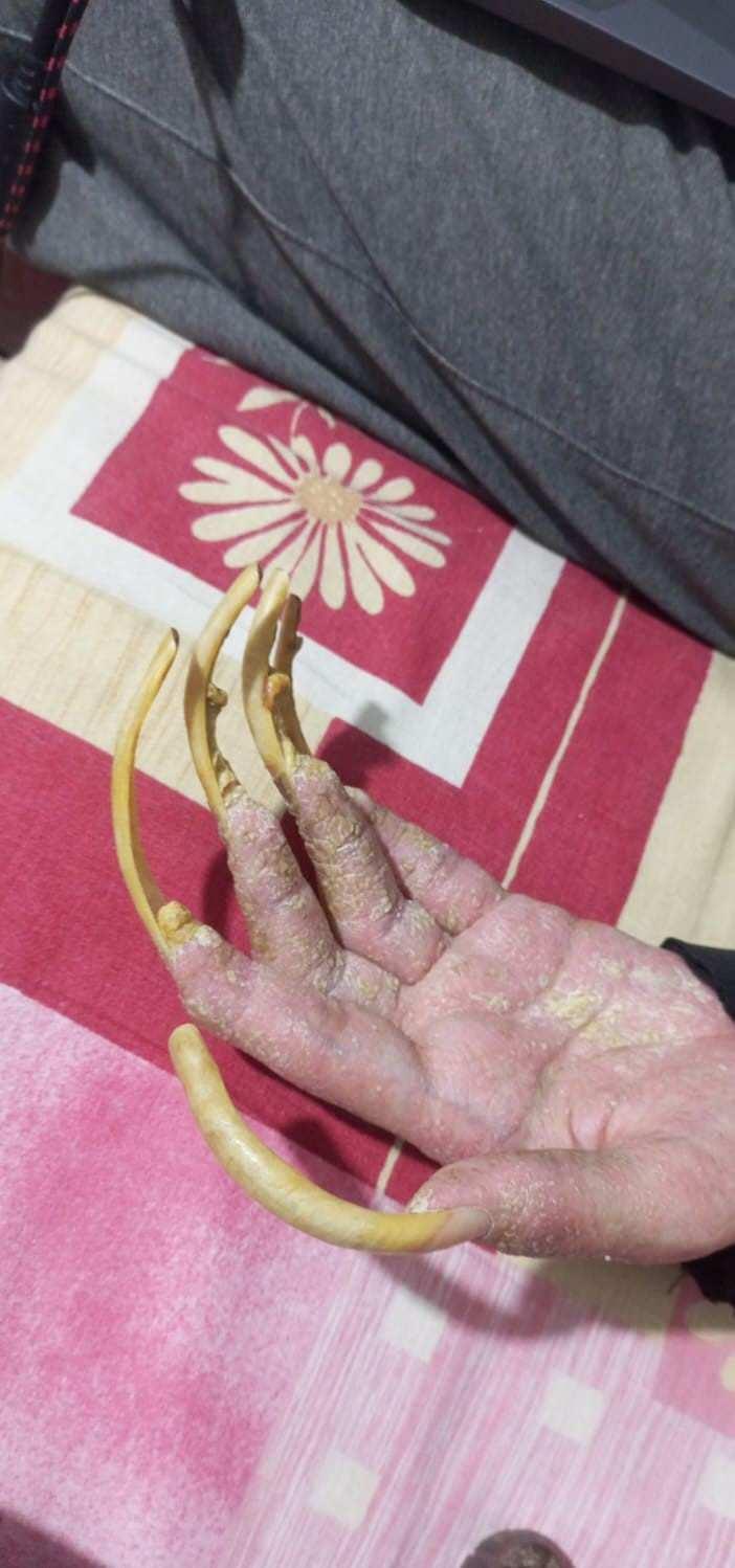 <p>Yaşamak için gerekli ihtiyaçlarını gideren genç adam; ne duş alıyor ne de tırnaklarını kesmek gibi özel gereksinimlerini yerini getiriyor. </p>
