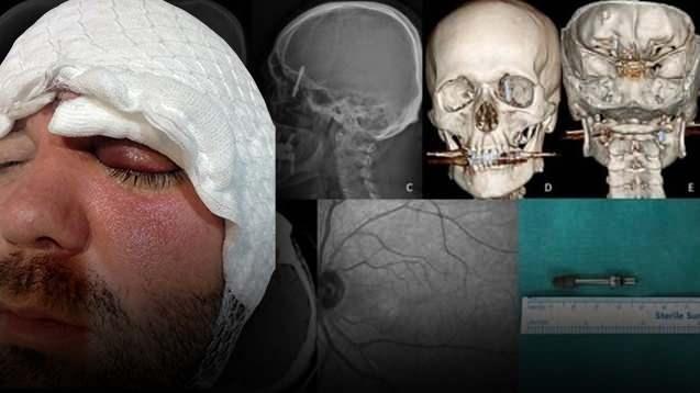 <p>Bursa'da diş tedavisi için gittiği özel klinikte yaptırdığı implant işlemi, <strong><em>fabrika işçisi Ramazan Yılmaz'ın (40) hayatını kabusa çevirdi. </em></strong></p>