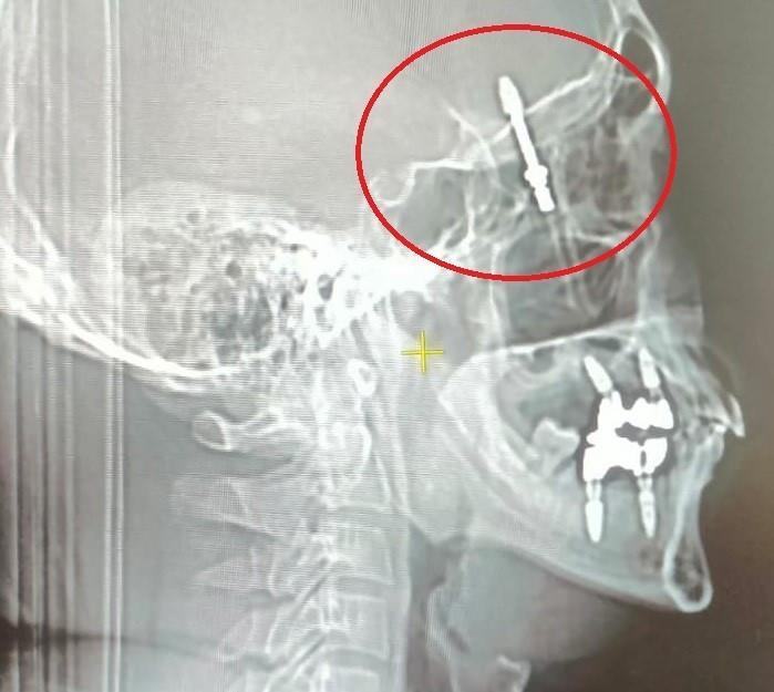 <p>İddiaya göre, doktor A.D.'nin hatalı müdahalesi sonucu<strong> <em><span style="color:#A52A2A">implant vidası çene kemiğini delip kafatasına saplandı.</span></em></strong></p>