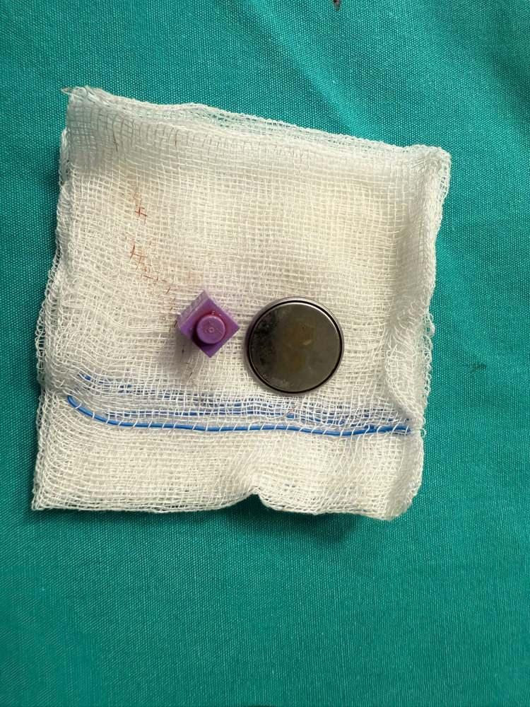 <p>A.Y.Ç.'ye yapılan röntgende, yemek borusunda düğme pil ve lego parçası oyuncağa rastlandı. </p>
