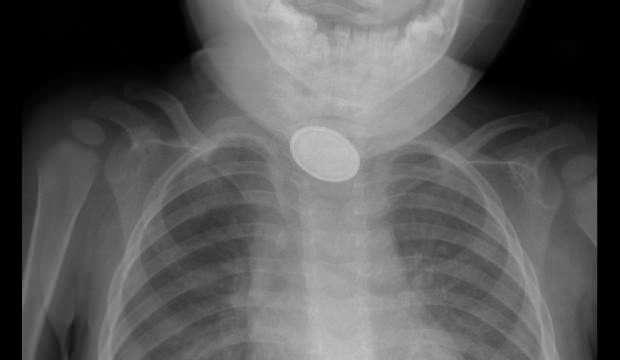 <p>Yaklaşık 3 saatlik süren operasyonun ardından A.Y.Ç.'nin yemek borusuna kaçan düğme pil ile lego oyuncak parçası çıkarıldı.</p>
