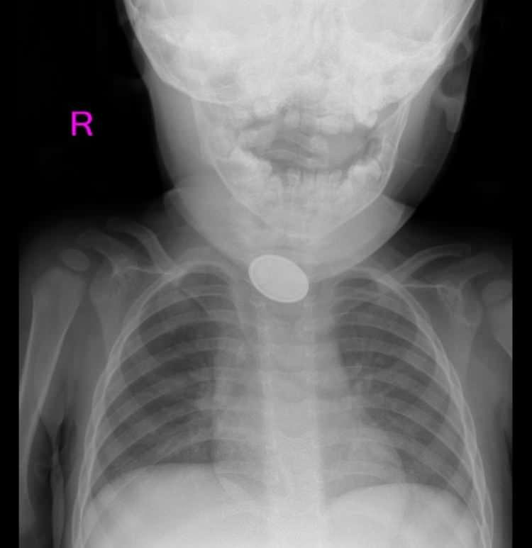 <p><strong>"Oyuncak olan odaya gidip, bir cisim yutmuş. 4 yaşındaki oğlum, 'Anne kardeşim lego yuttu' dedi. İlk yardım biliyorum. Müdahale ettim ama çıkmadı. 'Herhalde yuttu artık, dışkısından çıkar' diye düşündüm. Daha sonra yutma güçlüğünü gördüğümde hemen geldik. Pil de olduğunu öğrendik. Meğer önce pil daha sonra lego parçası yutmuş. Şoka uğradık. Çok korktuk. Bizim en çok korktuğumuz şey, bir şeyleri yutmasıydı. Normalde dikkat ederdik ama kaşla göz arasında olan bir şey. Bundan sonra daha dikkatli olacağız. Herkes dikkatli olsun. Çok zor bir ameliyat geçirdi. Erman hocam ve ekibi olmasa çocuğum kucağımda olmayabilirdi. Tam teşekküllü bir hastane olduğu için hemen buraya geldik. Başka bir hastane düşünmedik. Konum olarak uzağız aslında ama hemen geldik. Herkesten çok memnunuz" </strong></p>

