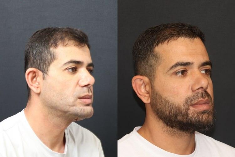 <p>Doç. Dr. Özkan, bu tür vakalarda mikrocerrahinin önemine dikkat çekerek, <strong>"Kompozit doku eksikliklerinde vaskülerkemik transferi bize büyük avantaj sağlıyor. Hastamız şu an kendi beslenmesini sağlayabiliyor. Önümüzdeki süreçte kemik iyileşmesini tamamladıktan sonra diş implantları yerleştireceğiz ve hastamız çok daha rahat beslenebilecek."</strong> ifadelerini kullandı.</p> <p> </p> <p><em><strong>KAYNAK: DHA</strong></em></p> 