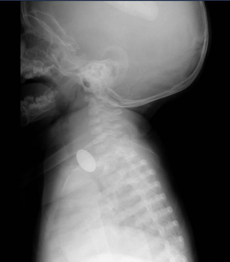 <p>Bir süre sonra A.Y.Ç.'nin yutma güçlüğü çektiğini gören Tuğba Yılmaz, Kayseri Şehir Hastanesi'ne başvurdu. </p>
