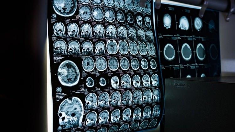 <p><strong>Öte yandan Horikawai tekniğin beyindeki dil merkezlerinden bağımsız çalıştığını açıkladı. Bu da araştırmanın afazi veya ALS gibi konuşma yetisini etkileyen hastalıklarda potansiyel yardım sağlayabileceğine dikkat çekti.</strong></p>
