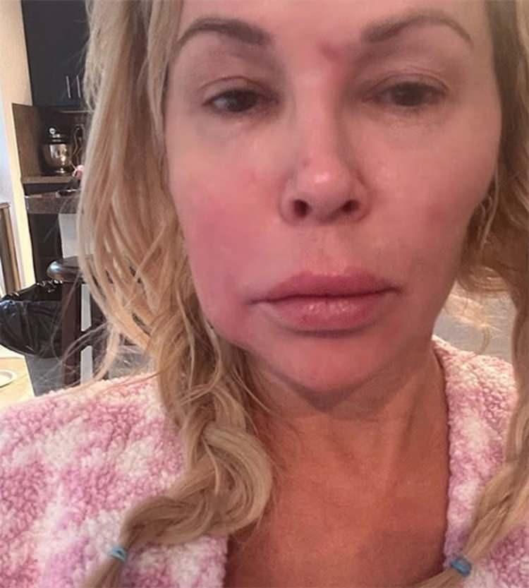 <p>2<strong>023 yılında bir çekim için gittiği Fas'ta kaptığı bir tür parazitin yüzünü böyle deforme ettiğini iddia eden ünlü yıldız, "Dürüst olmak gerekirse, çok sayıda doktorum var ve çok sayıda test yaptırdım. 10 bin dolara laboratuvar testleri yaptırdım. Güneşin altındaki her türlü testi yaptılar. 'Yeni bir parazit olabilir' dediler." demişti.</strong></p>
