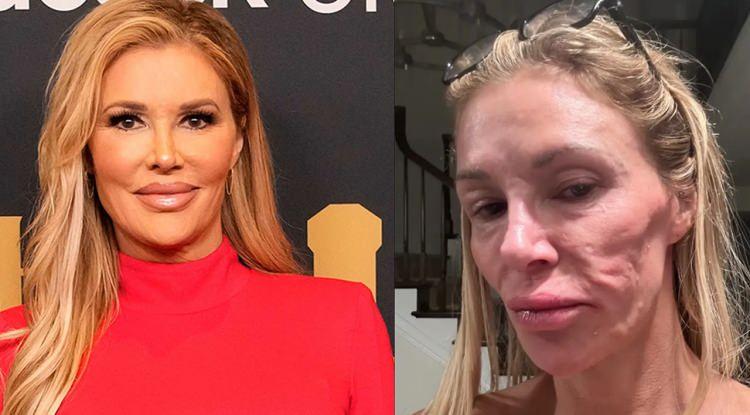<p><span style="color:#A52A2A"><em><strong>ABD'li TV yıldızı Brandi Glanville, bir süredir yaşadığı sağlık sorunuyla gündemdeydi. Yüzünün giderek şekil değiştirdiğini söyleyerek, sayısız kez doktora giden ünlü isim, sonunda bu sorununa teşhis konulduğunu duyurdu.</strong></em></span></p>

