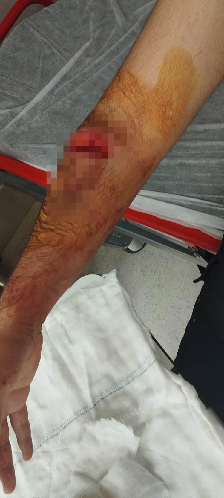 <p><span style="color:#A52A2A"><strong>HASTANEYE GİTTİ </strong></span></p>

<p> </p>

<p>Kolundan yaralanan Cansız, durumu site müdürüne haber verdikten sonra hastaneye gitti.</p>
