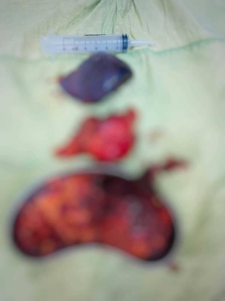 <p>&Ccedil;etin'in yapılan tetkiklerinde biri b&ouml;breğin alt kısmında diğeri b&ouml;brek &uuml;st&uuml; bezinde olmak &uuml;zere yaklaşık 15 santimetre b&uuml;y&uuml;kl&uuml;ğ&uuml;nde iki ayrı kitle tespit edildi.</p>
