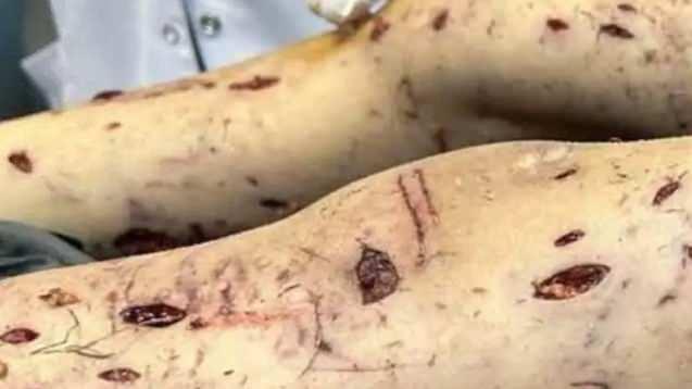 <p><strong><span style="color:#A52A2A">15'İNCİ B&Uuml;Y&Uuml;K OPERASYONLA DERİ NAKLİ YAPILDI</span>&nbsp;</strong></p>

<p>&nbsp;</p>

<p>Yılmaz, 3 ay Hacettepe &Uuml;niversitesi Tıp Fak&uuml;ltesi Hastanesi'nde art arda yapılan ameliyatlardan sonra mart ayında taburcu edildi ancak tedavi s&uuml;reci devam etti.</p>

<p>&nbsp;</p>

<p>Tunahan Yılmaz'a, 26 Haziran 2025'teaynı hastanede ge&ccedil;irdiği&nbsp;<span style="color:rgb(165, 42, 42)"><em><strong>15'inci b&uuml;y&uuml;k operasyonla deri nakli yapıldı.</strong></em></span></p>
