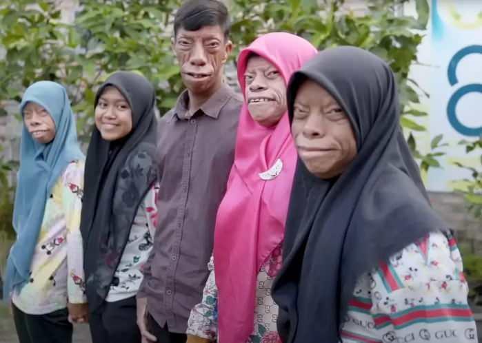 <p><strong>Farklı g&ouml;r&uuml;n&uuml;mleriyle sosyal medyada viral olan Endonezyalı bir aile, d&uuml;nya &ccedil;apında geniş yankı uyandırıyor. "S&uuml;r&uuml;ngen surat" ya da "kertenkele surat" lakaplı aile 2014 yılında keşfedildi. G&uuml;nl&uuml;k yaşamlarını t&uuml;m samimiyetiyle paylaşan aile, nadir g&ouml;r&uuml;len genetik bir durumla verdikleri m&uuml;cadeleyle farkındalık oluşturdular.</strong></p>
