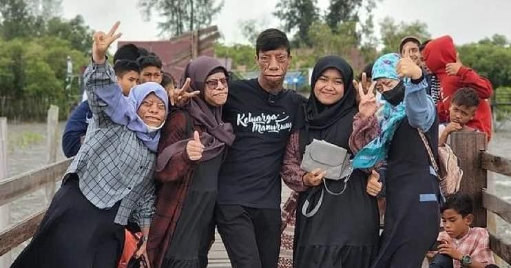 <p><span style="color:#EE82EE"><strong>NADİR BİR GENETİK DURUM</strong></span></p>

<p><strong>Manurung ailesinin 6 &ccedil;ocuğundan 4'&uuml;, nadir g&ouml;r&uuml;len bir y&uuml;z rahatsızlığıyla yaşıyor. Tiur adındaki kardeşte ise herhangi bir bozukluk işareti yok.</strong></p>
