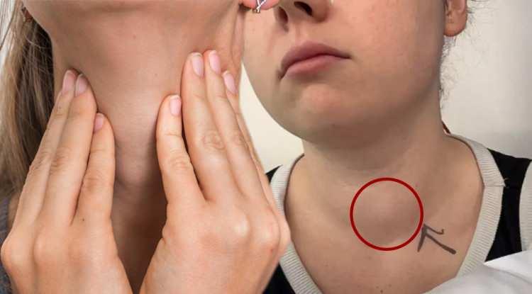 Yıllarca şikayetleri g&ouml;rmezden gelindi! Tiroid kanseri olduğunu arkadaşları fark etti