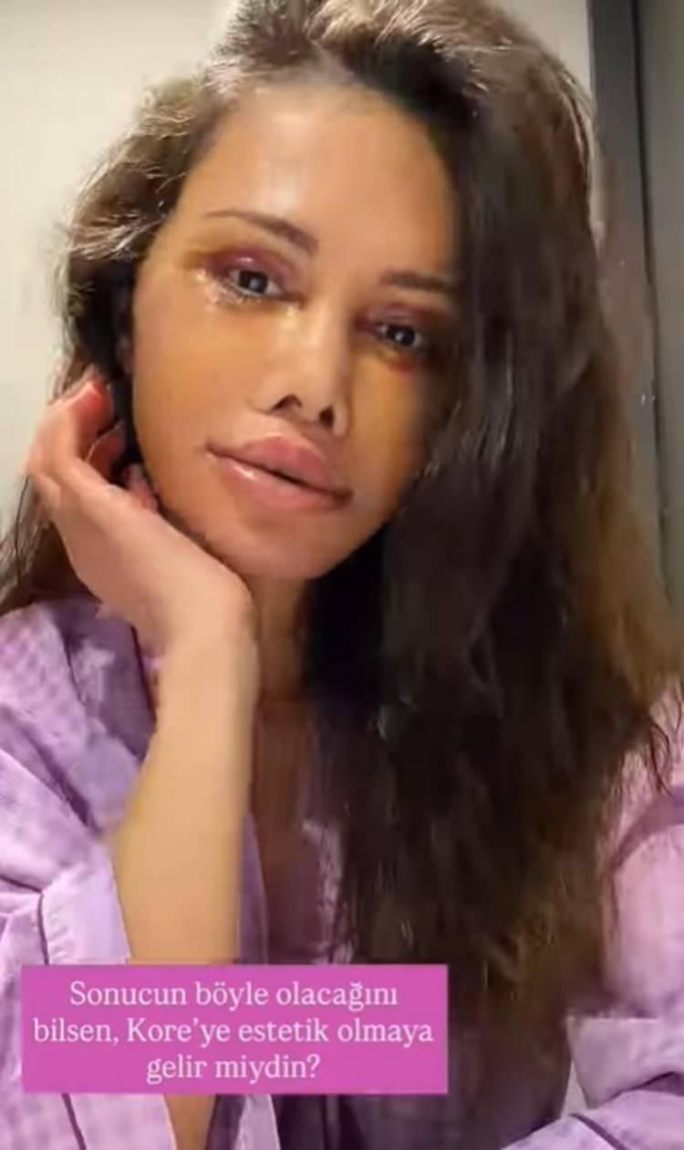 <p><strong>Y&Uuml;Z NAKLİ OLDU</strong></p>

<p>Kore'de y&uuml;z nakli ge&ccedil;iren &uuml;nl&uuml; fenomen sırayla y&uuml;z&uuml;n&uuml; paylaşarak ge&ccedil;irdiği y&uuml;z nakli operasyonu ile ilgili bilgiler paylaştı.&nbsp;</p>
